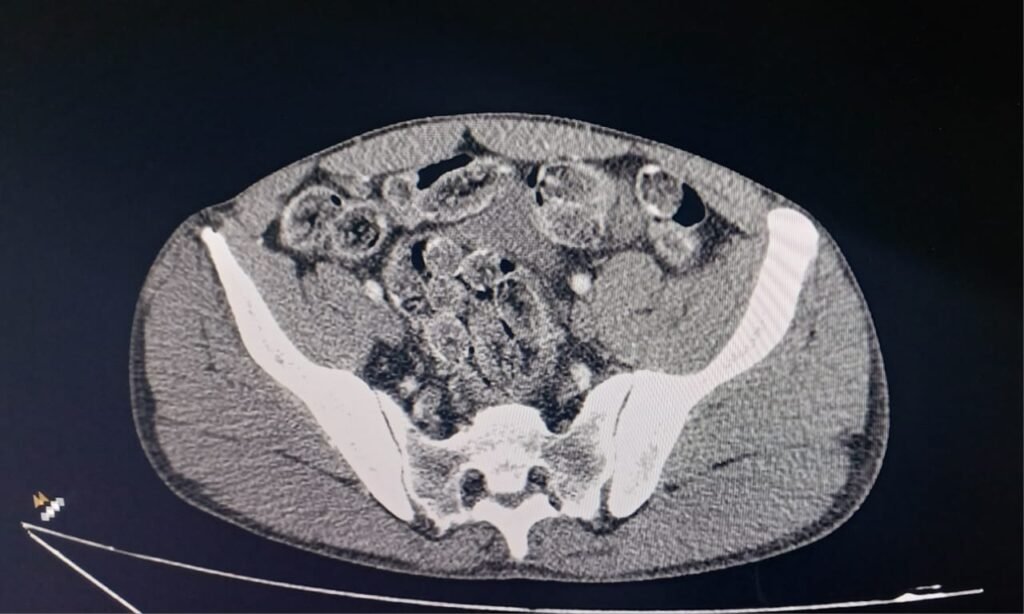 TOR prende trio com cápsulas de cocaína no estômago