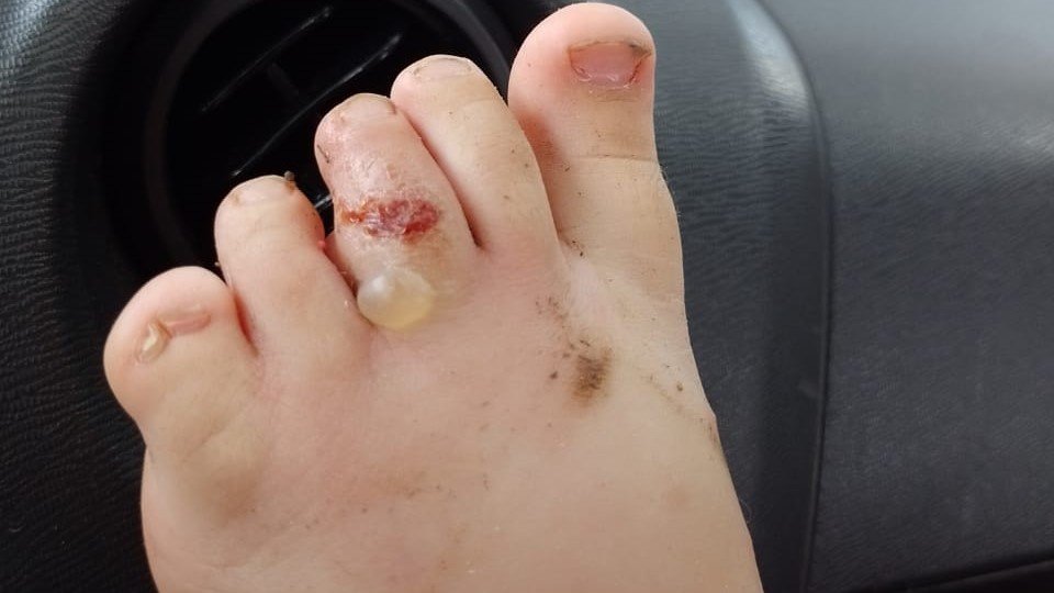 Mãe diz que filho ficou dia todo em creche após ser picado por aranha