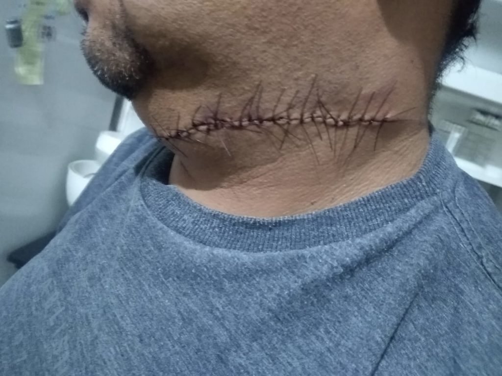 PMs salvam vida de motociclista ferido gravemente com cerol