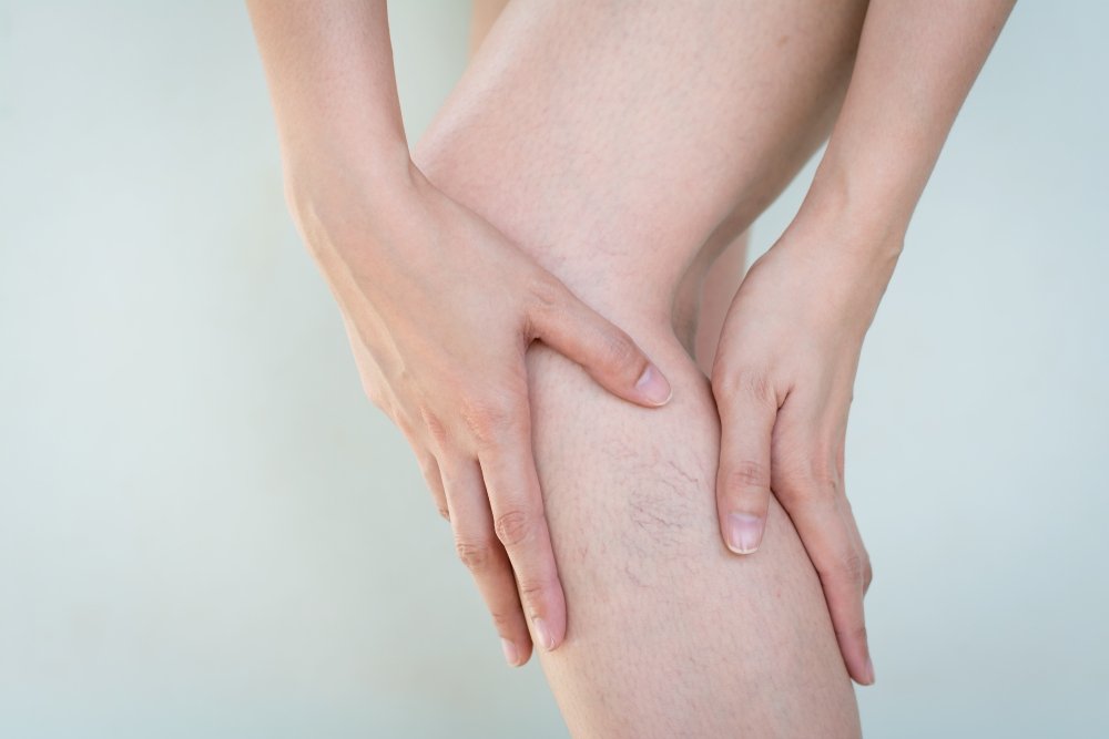 Verão chegou: casos de varizes aumentam em época de altas temperaturas