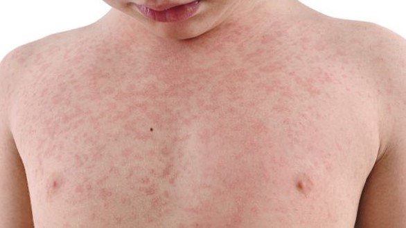 Prefeitura volta atrás e diz que há quatro casos suspeitos de sarampo